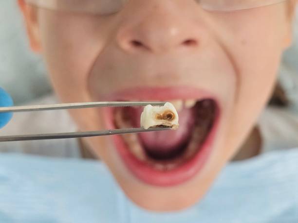 Best Emergency Wisdom Tooth Extraction in Anna, IL